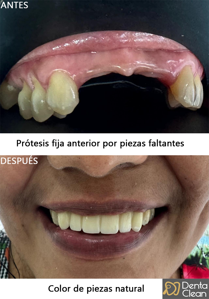 Prótesis fija anterior por piezas faltantes