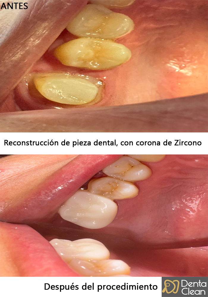 Reconstrucción de pieza dental, con corona de Zircono