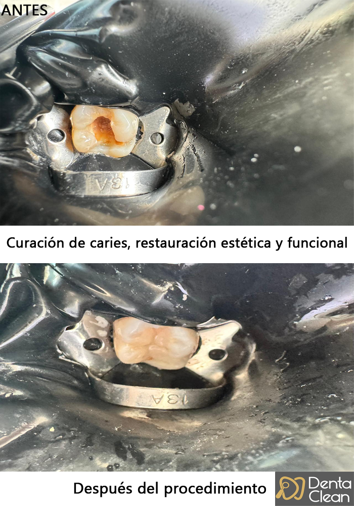 Curación de caries, restauración estética y funcional