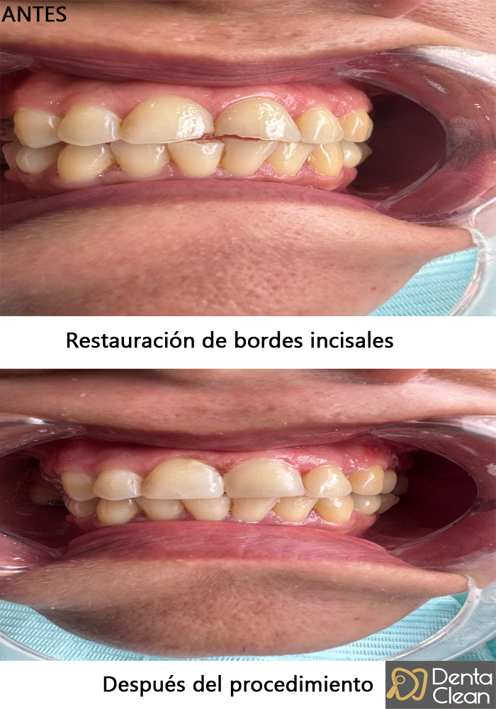 Restauración de bordes incisales