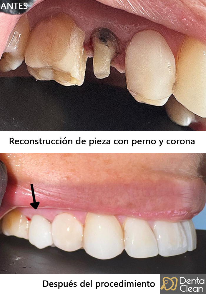 Reconstrucción de pieza con perno y corona