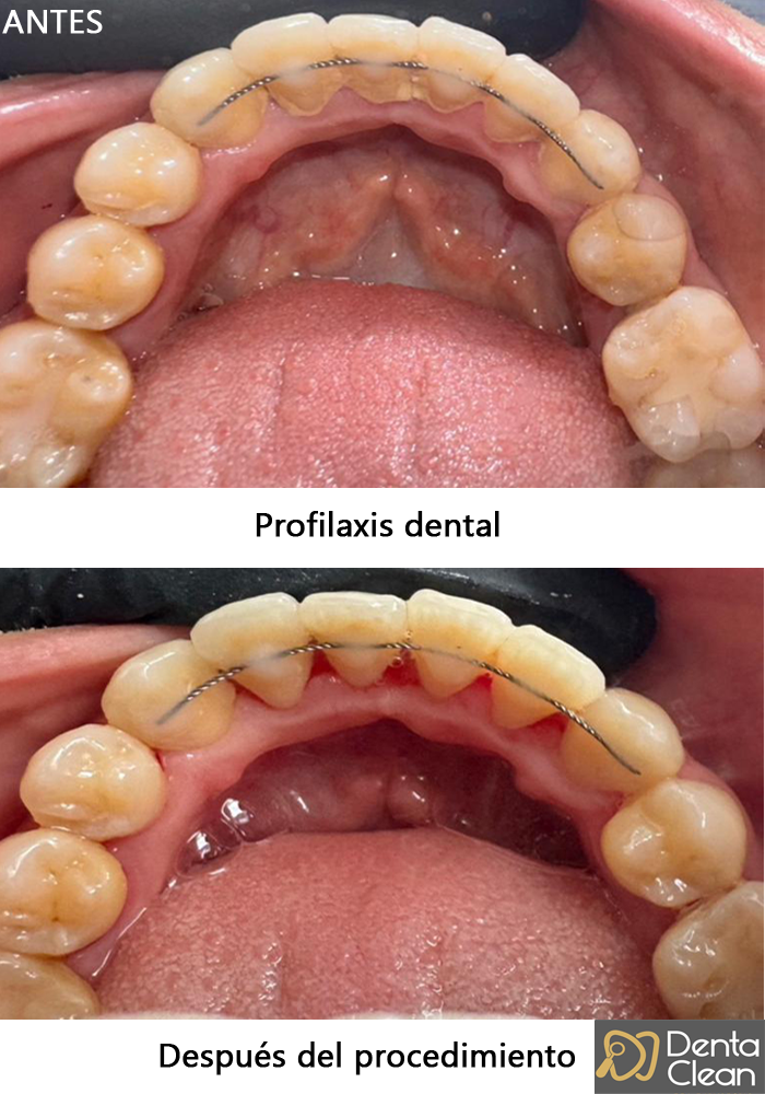 Profilaxis dental