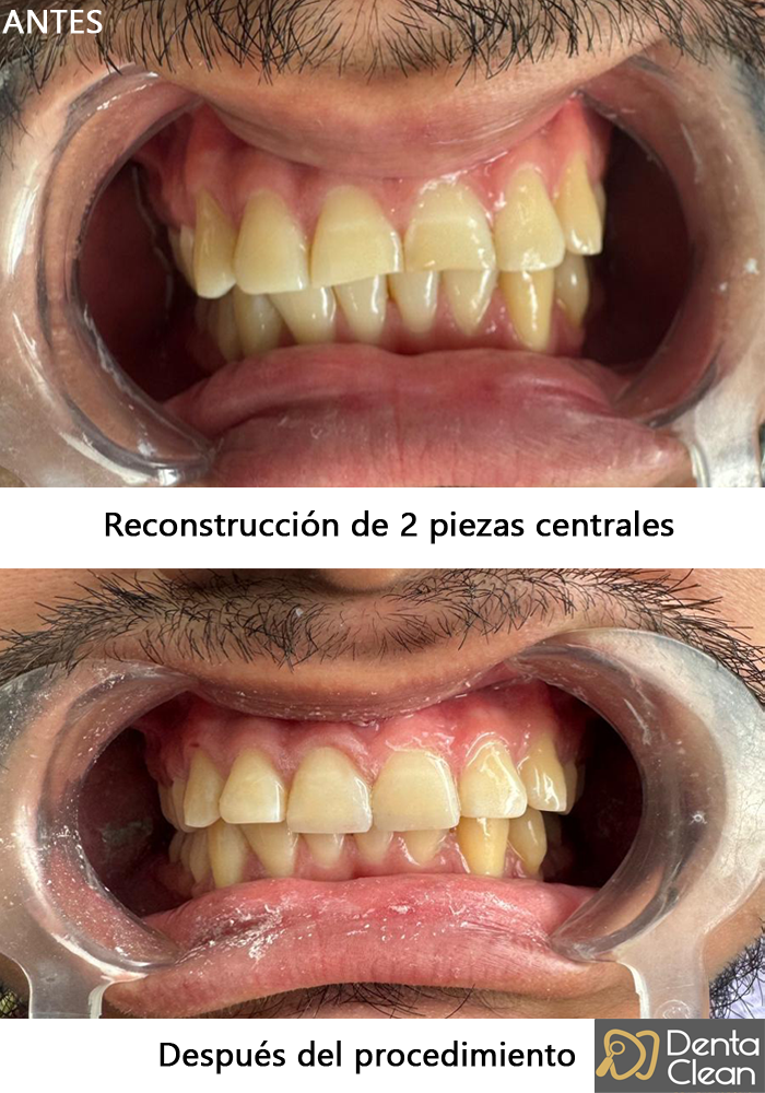 Reconstrucción de 2 piezas centrales